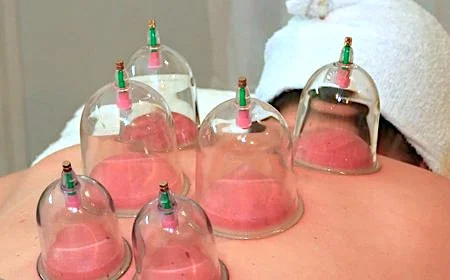 cupping-on-back