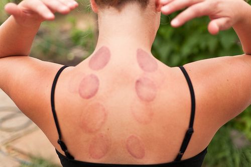 Cupping-back