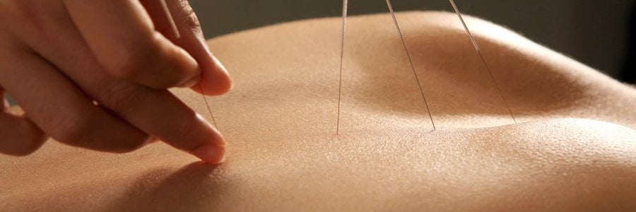 acupuncture-closeup